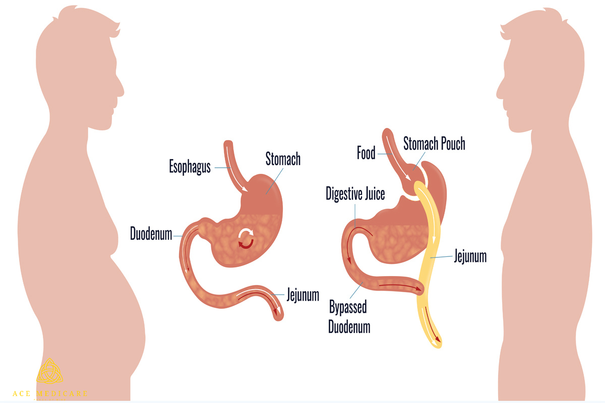 Choosing the Best Surgeon for Your Gastric Bypass Surgery